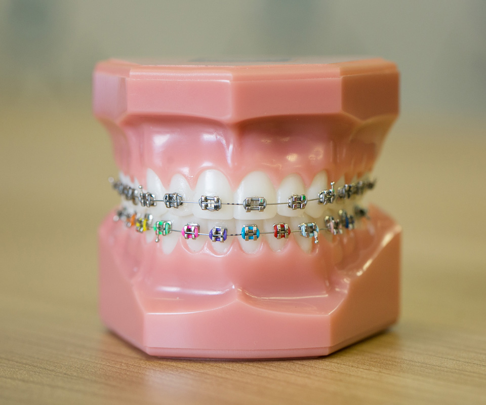 What are metal braces?