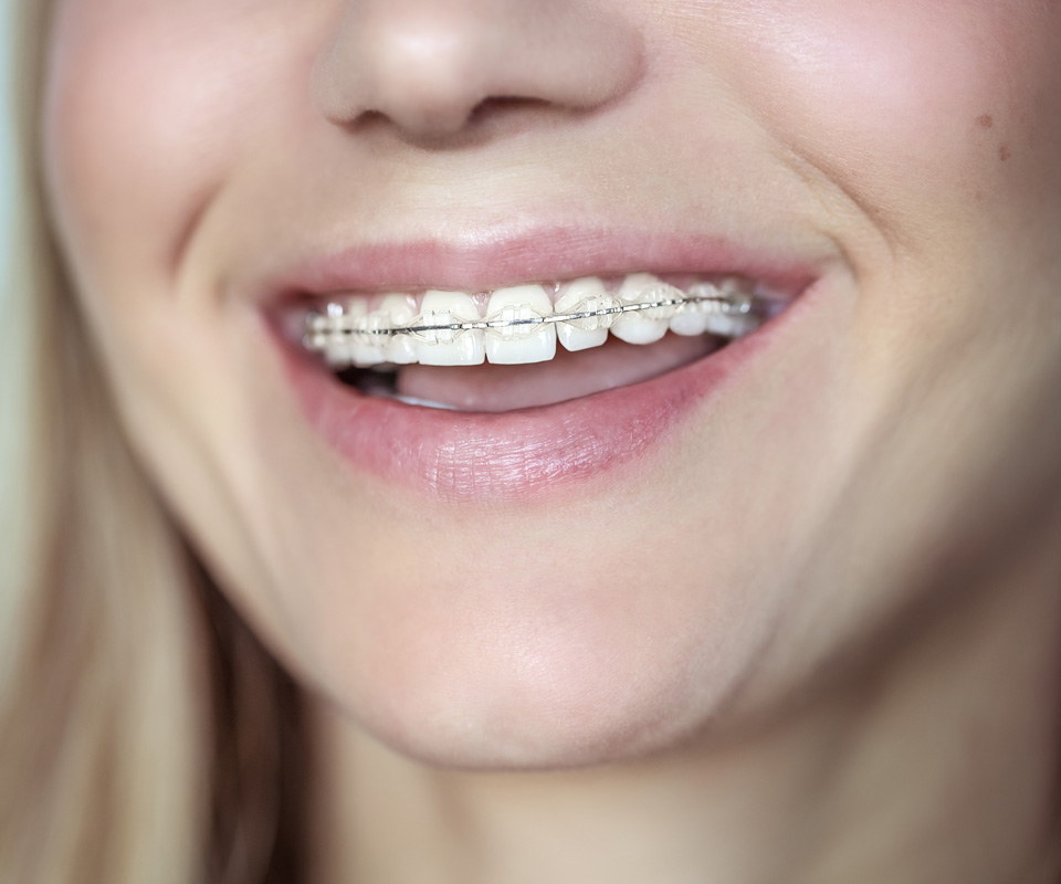 What are clear braces?